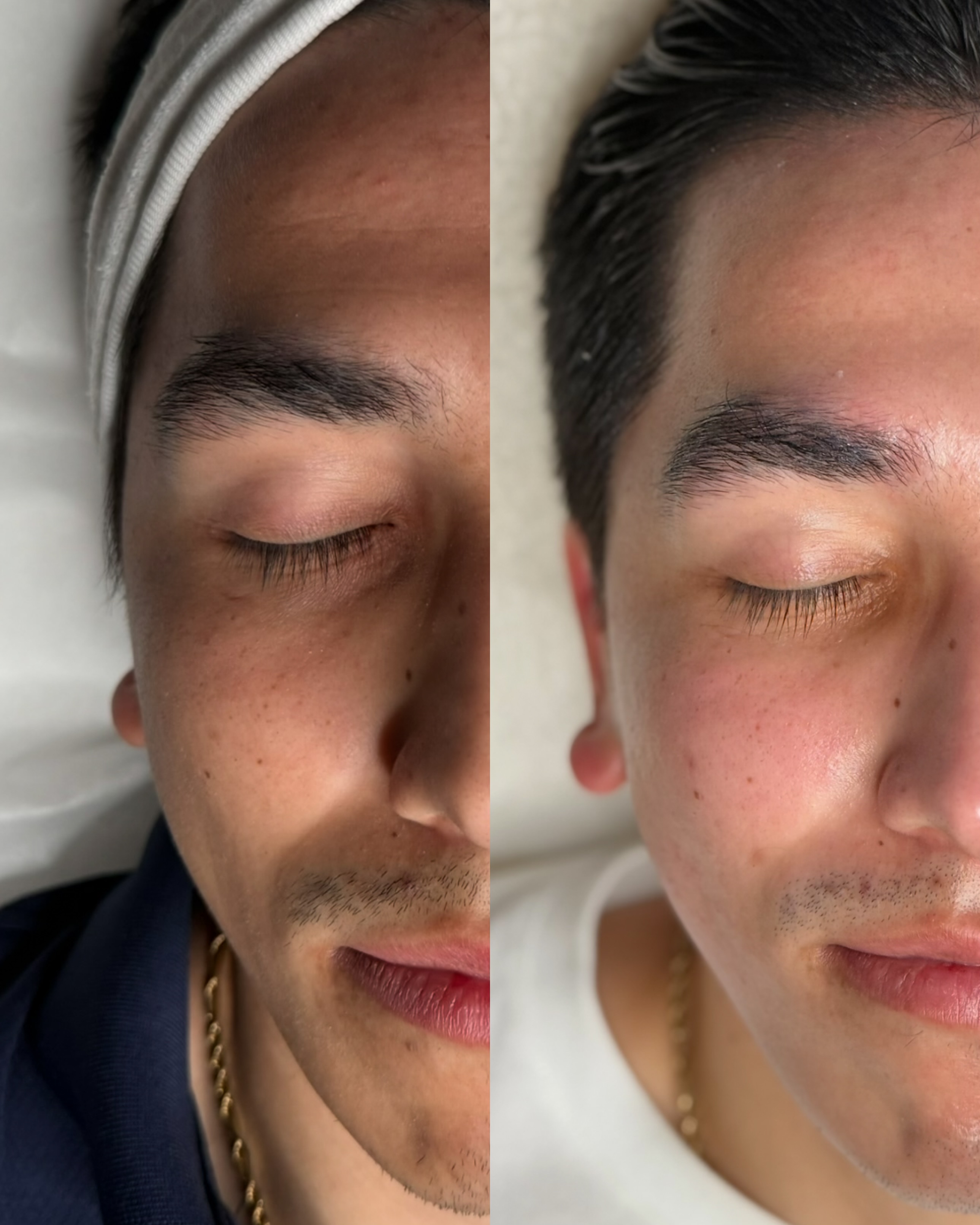 Side-by-side close-up of a person's face, showing skin and facial features, with eyes closed, one side appears darker, the other lighter.